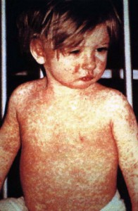 A child with the measles poses for a photo. The rash on the child typically appears on the fourth day of being sick. (Photo courtesy of the United States Centers for Disease Control and Prevention)
